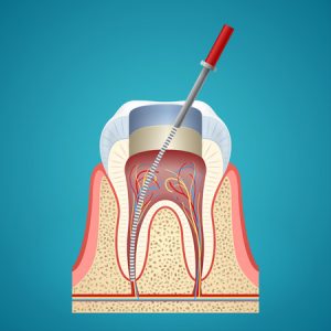 26973277 - dental injection in cutaway on blue background