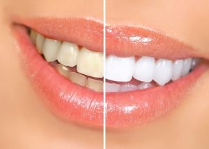 7251819 - mouth and teeth before and after whitening