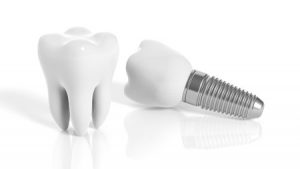 40217712 - tooth and dental implant isolated on white background