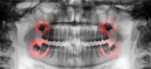 63075964 - wisdom teeth toothache