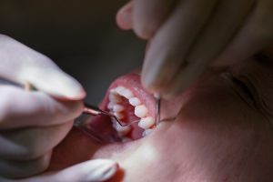 43437109 - patient at dentists office, getting soft-tissue probed and teeth cleaned of tartar and plaque, preventing periodontal disease. dental hygiene, painful procedures and prevention concept.
