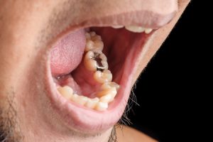 49814715 - dental filling | tooth filling | cavity filling | silver filling